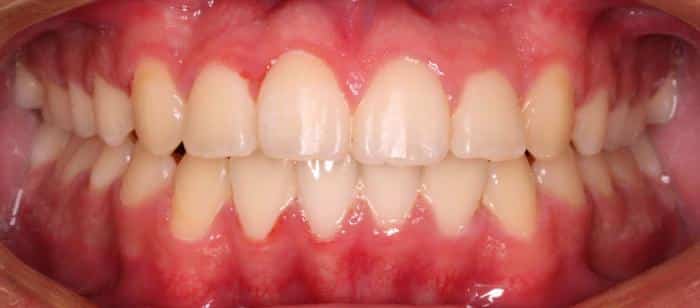 Adult Teen - Open bite Before After Smile Results