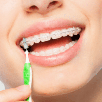 Closeup of a person cleaning their braces with a small toothbrush, representing products for cleaning and maintaining your braces